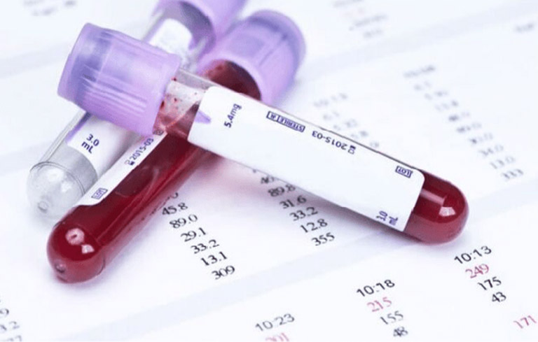 Xét nghiệm máu là một phương pháp phổ biến giúp chẩn đoán áp xe chính xác
