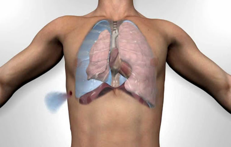 Lao màng phổi là thủ phạm hàng đầu gây tràn dịch màng phổi