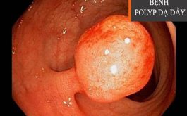 Bệnh Polyp hang vị dạ dày