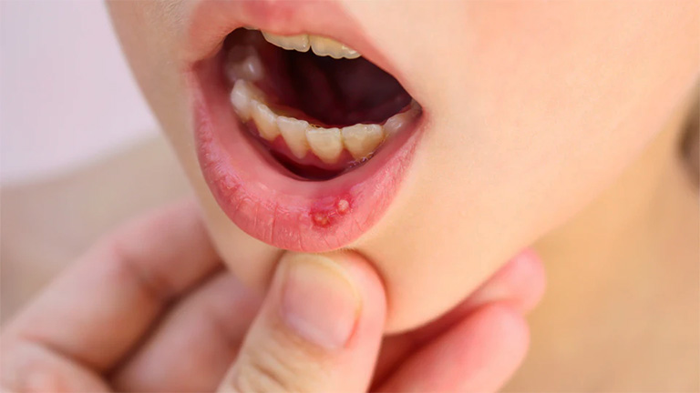 Trẻ bị viêm lở loét miệng lưỡi là do đâu? Cha mẹ cần phải làm gì để khắc phục tình trạng này?