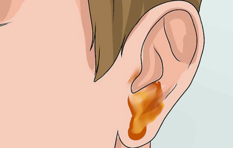 Viêm tai giữa là bệnh lý phổ biến ở trẻ