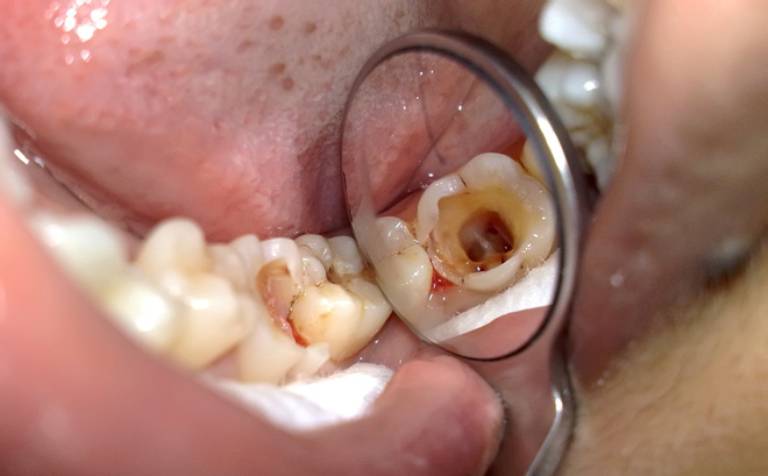 Răng bị hoại tử tủy thường gây ra mùi hôi khó chịu