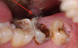 Hoại tử tủy răng là giai đoạn tiếp theo của tình trạng viêm tủy không hồi phục