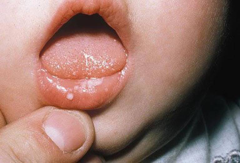 Nhiệt miệng ở trẻ sơ sinh không quá nguy hiểm nhưng cần có biện pháp xử lý phù hợp