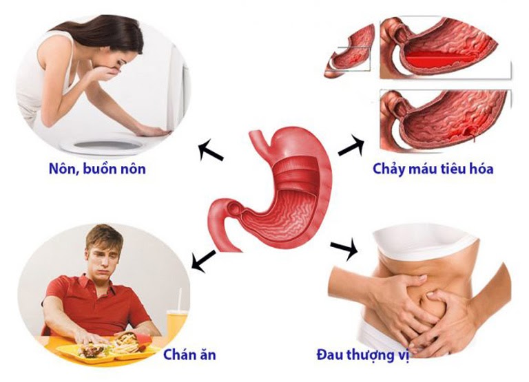 Hẹp hang vị dạ dày gây ra những triệu chứng khó chịu cho người bệnh