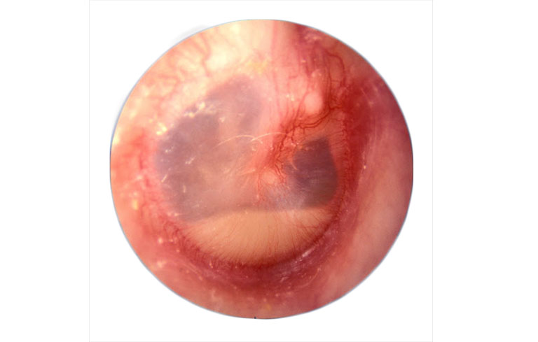Dịch tai xuất hiện sau màng nhĩ đóng kín là dấu hiệu điển hình của bệnh