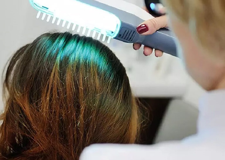 Trị rụng tóc bằng Laser được đánh giá là khá hiệu quả 