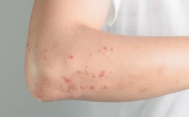 Nguyên nhân gây nổi mẩn đỏ trên da có thể là do các bệnh lý ngoài da hoặc bên trong cơ thể.
