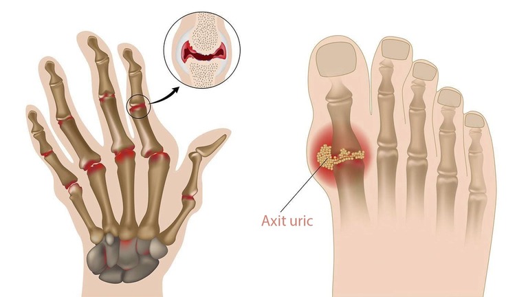 Nổi cục u ở khớp ngón tay là bệnh gì?