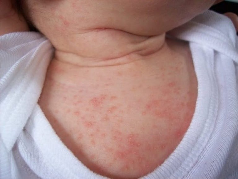 Trẻ bị dị ứng thời tiết có làn da dễ bị sưng, nổi mẩn đỏ
