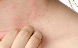 Triệu chứng nổi mẩn đỏ dưới da là hiện tượng dễ gặp và có thể cảnh báo bạn đang mắc một số bệnh da liễu