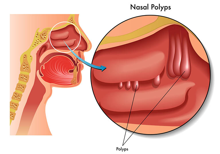 Polyp mũi là gì? Nguyên nhân, Dấu hiệu nhận biết, Điều trị