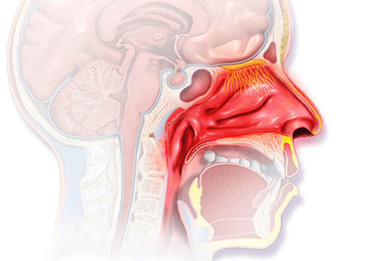 Viêm VA cấp tính là tình trạng viêm nhiễm cấp tiến triển ở tổ chức lympho nằm ngay phía sau vòm miệng