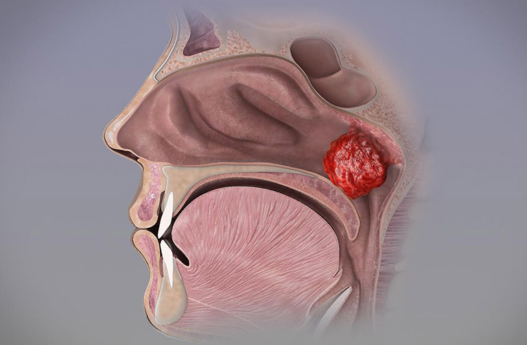Khối lympho VA khi bị viêm ở mức độ 3 có xu hướng tăng kích thước, đè lên cửa khẩu cái, che lấp hết mũi sau khoảng 50 - 75%