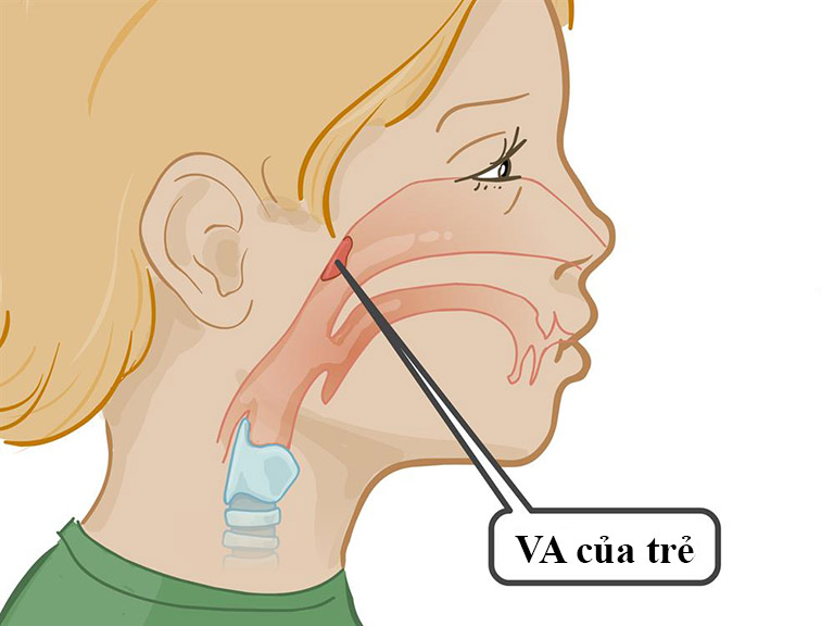 VA là bộ phần nằm sau mũi, trên lưỡi gà nên bị khuất và thường bác sĩ bỏ qua trong mỗi lần thăm khám và tầm soát