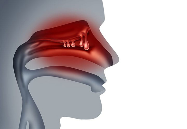 Viêm xoang polyp mũi là biến chứng của bệnh viêm xoang mãn tính với sự xuất hiện của khôi polyp trong khoang mũi