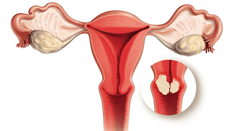 Hình ảnh ung thư cổ tử cung ở giai đoạn 2 - 3