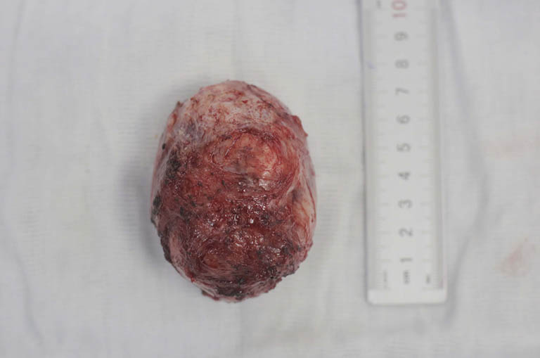 Phẫu thuật bóc nhân xơ hoặc cắt tử cung khi u xơ tử cung có kích thước lớn