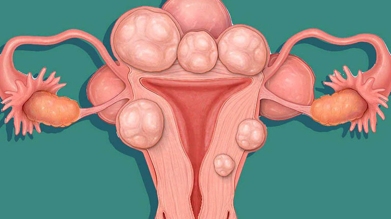 U xơ tử cung là những khối u lành tính hình thành và phát triển trong cổ tử cung