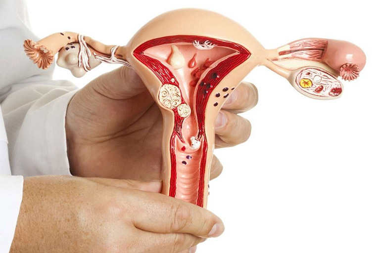 U xơ tử cung gây rong kinh kéo dài có thể là do vị trí của khối u xơ gần cửa cổ tử cung gây chèn ép và khiến kinh nguyệt không thể lưu thông bình thường
