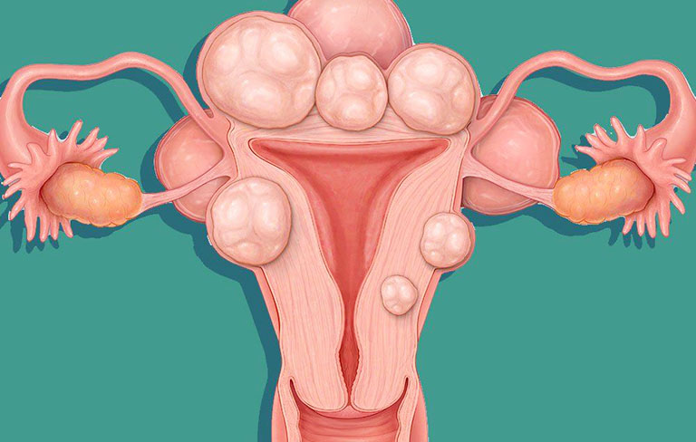U xơ tử cung là một khối u lành tính và không có khả năng phát triển thành ung thư nhưng có thể gây ra nhiều bất lợi cho sức khỏe của người phụ nữ