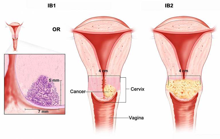Ung thư cổ tử cung: Nguyên nhân, Dấu hiệu và điều trị