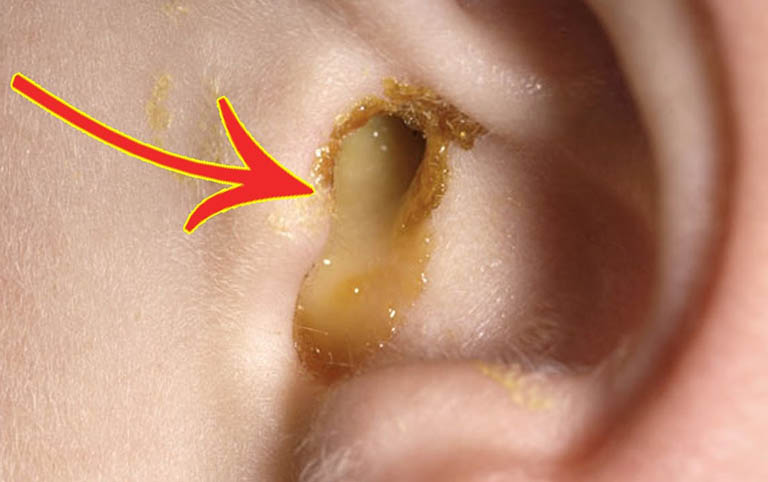 Có dịch mủ chảy ra từ trong tai