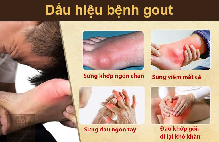 Dấu hiệu bệnh gout không được chủ quan