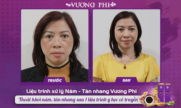 Cô giáo Kim Hoa trước và sau khi dùng Vương Phi