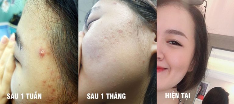 Hình ảnh làn da của cô bé Hoàng Chi sau 2 tháng dùng bài thuốc thảo dược Nhất Nam Hoàn Nguyên Bì