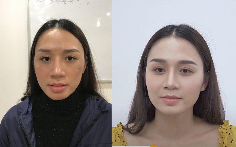 Chị Thu Hương trước và sau khi dùng giải pháp của bác sĩ Lê Phương
