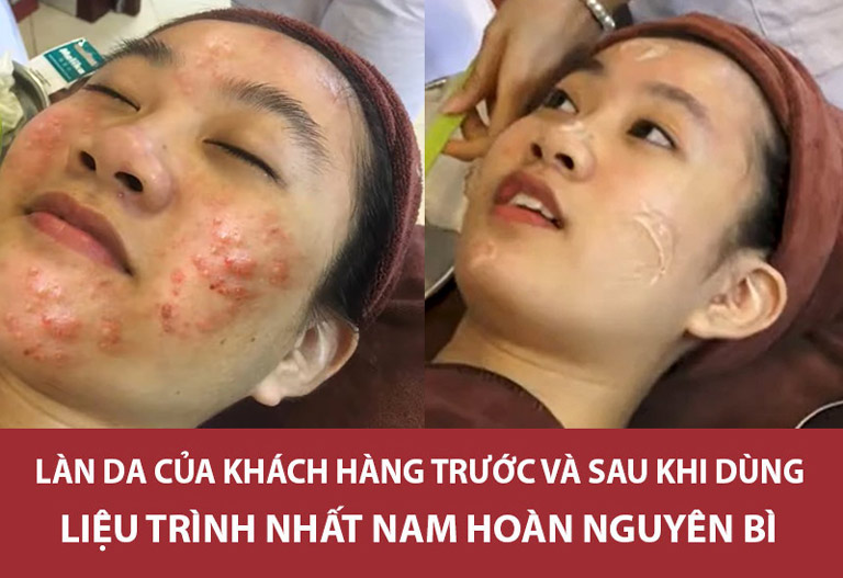 Làn da của khách hàng Hoàng Thu Hà đã cải thiện rõ rệt sau 3 tháng dùng liệu trình thảo dược Nhất Nam Hoàn Nguyên Bì